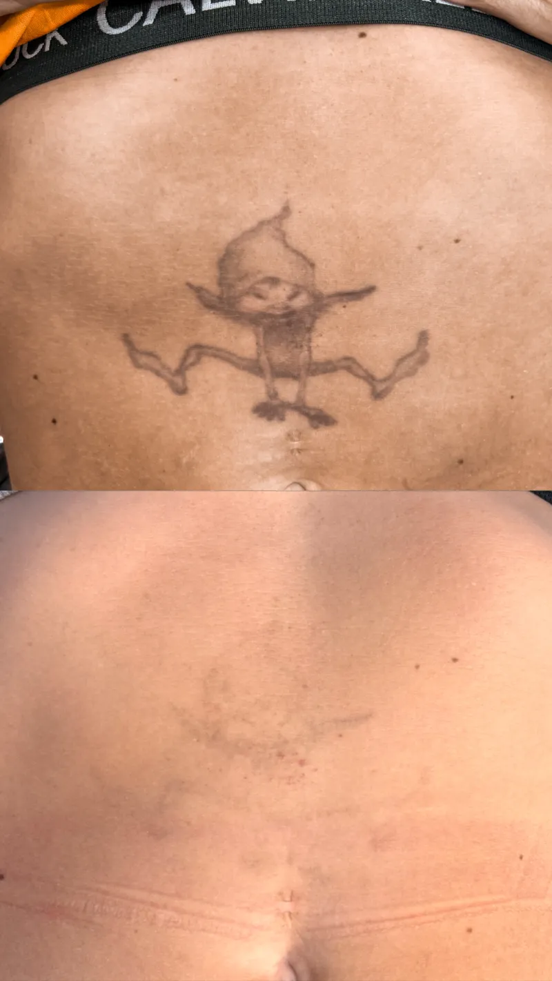 Antes e depois da remoção de tatuagem na região lombar