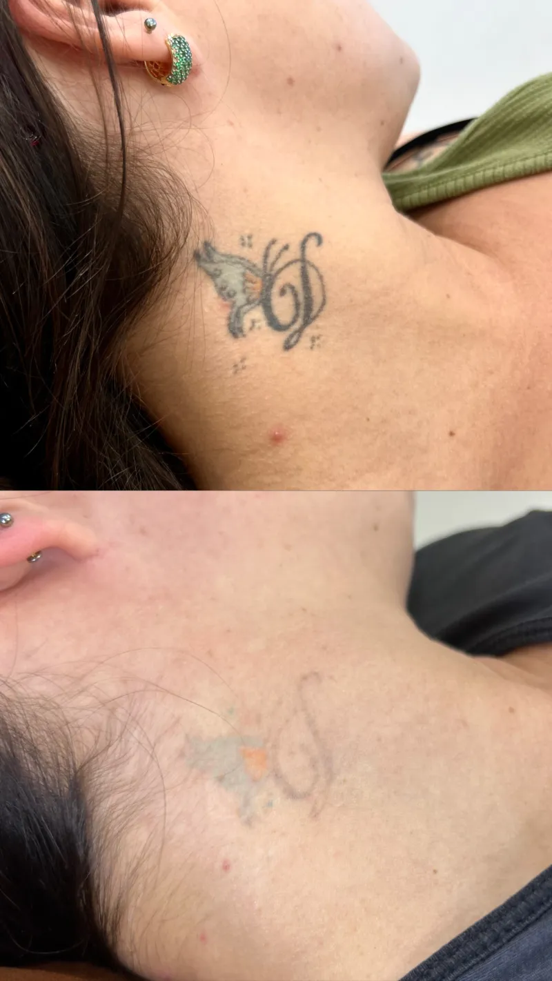 Antes e depois da remoção de tatuagem no pescoço