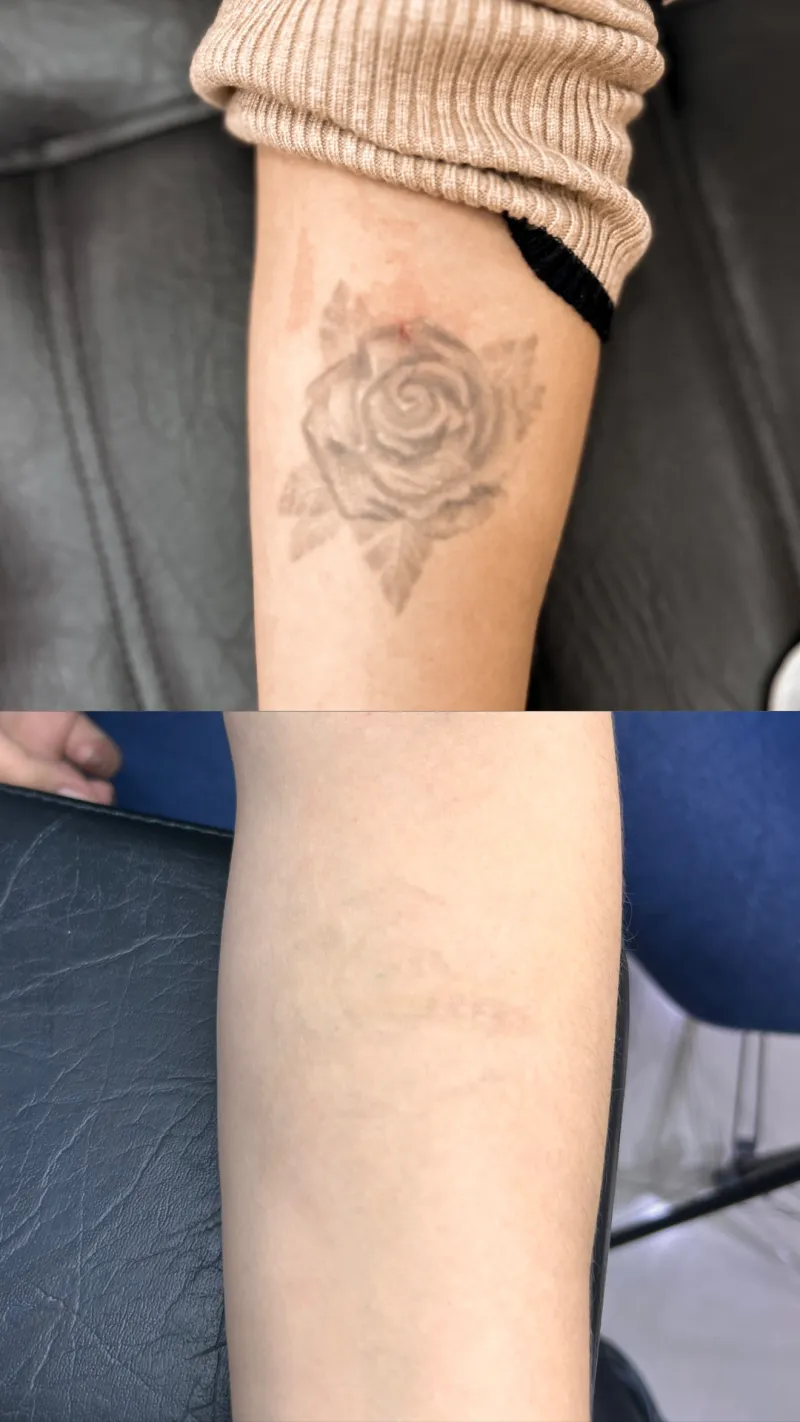 Antes e depois da remoção de tatuagem de rosa no braço