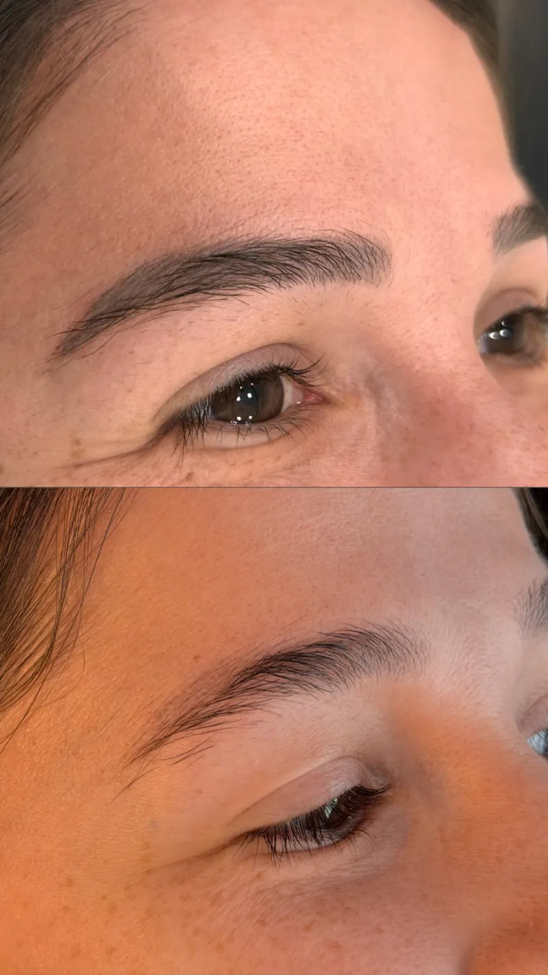 Antes e depois da remoção de micropigmentação de sobrancelha