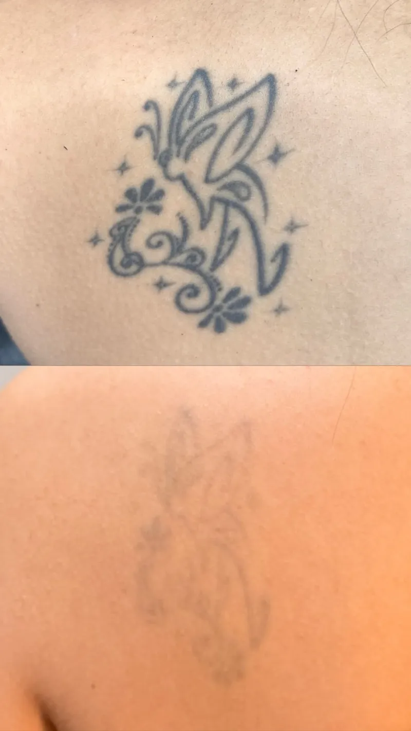 Antes e depois da remoção de tatuagem de borboleta